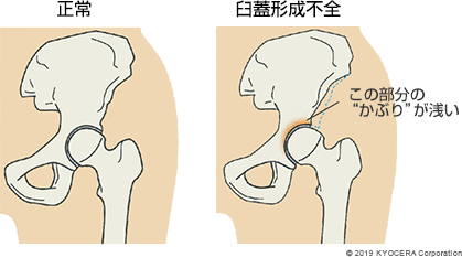 正常 臼蓋形成不全