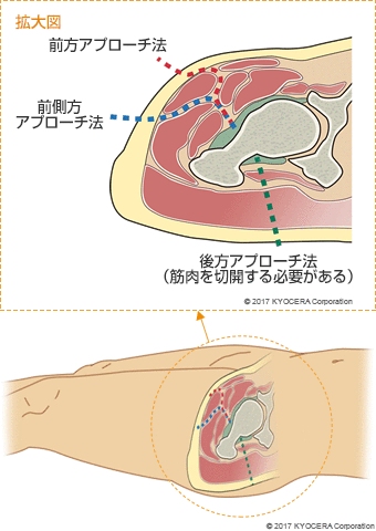 前方アプローチ法 前側方アプローチ法 後方アプローチ法(筋肉を切開する必要がある)