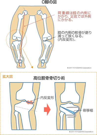 O脚の図 高位脛骨骨切り術