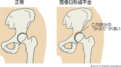 正常 寛骨臼形成不全