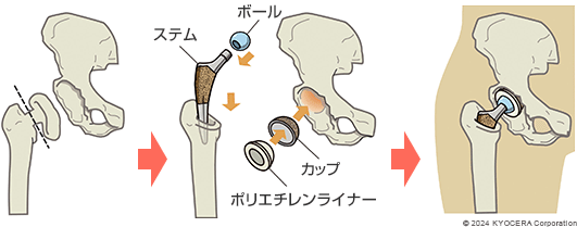人工股関節置換術の例