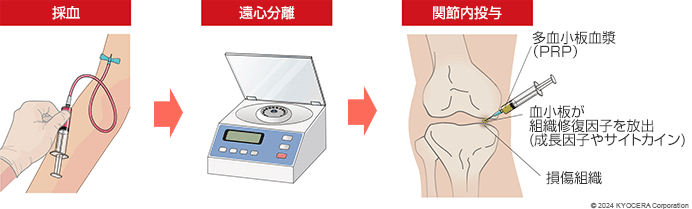 PRP療法イメージ図