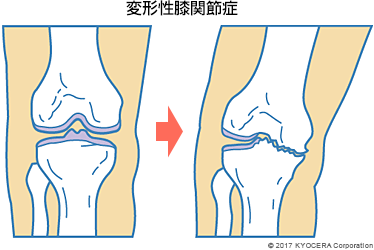 変形性膝関節症
