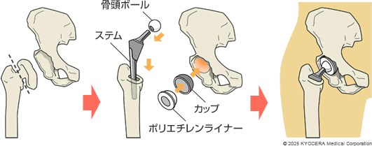 人工股関節置換術の例の図