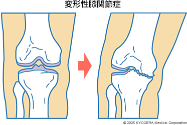 変形性膝関節症の図