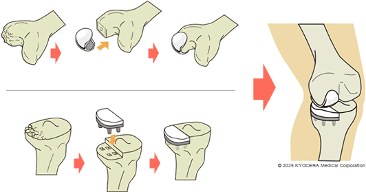 人工膝関節単顆置換術の図