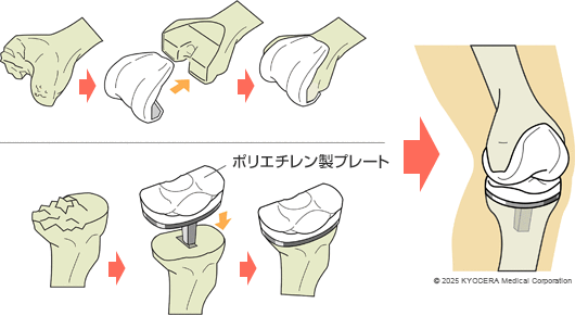 人工膝関節全置換術の図