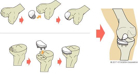 単顆人工膝関節置換術（UKA）