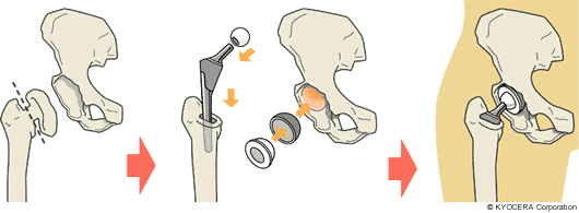 全人工股関節置換術（Total Hip Arthroplasty：THA）｜関節とは | 人工 